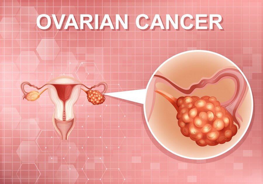 ovarian cancer