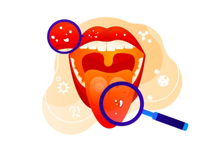 Recognizing Tongue Cancer: Symptoms, Risks, and Treatment