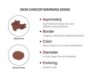 ABCDE rule to identify melanoma symptoms
