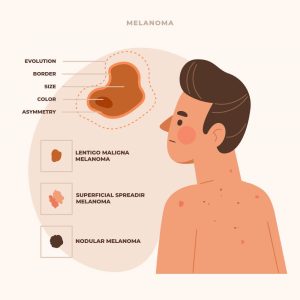 Melanoma