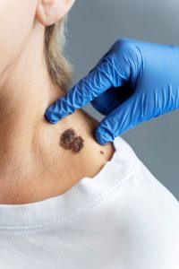 Melanoma Spots