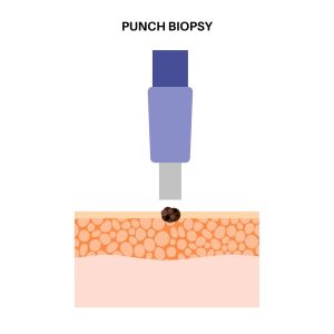 Punch biopsy