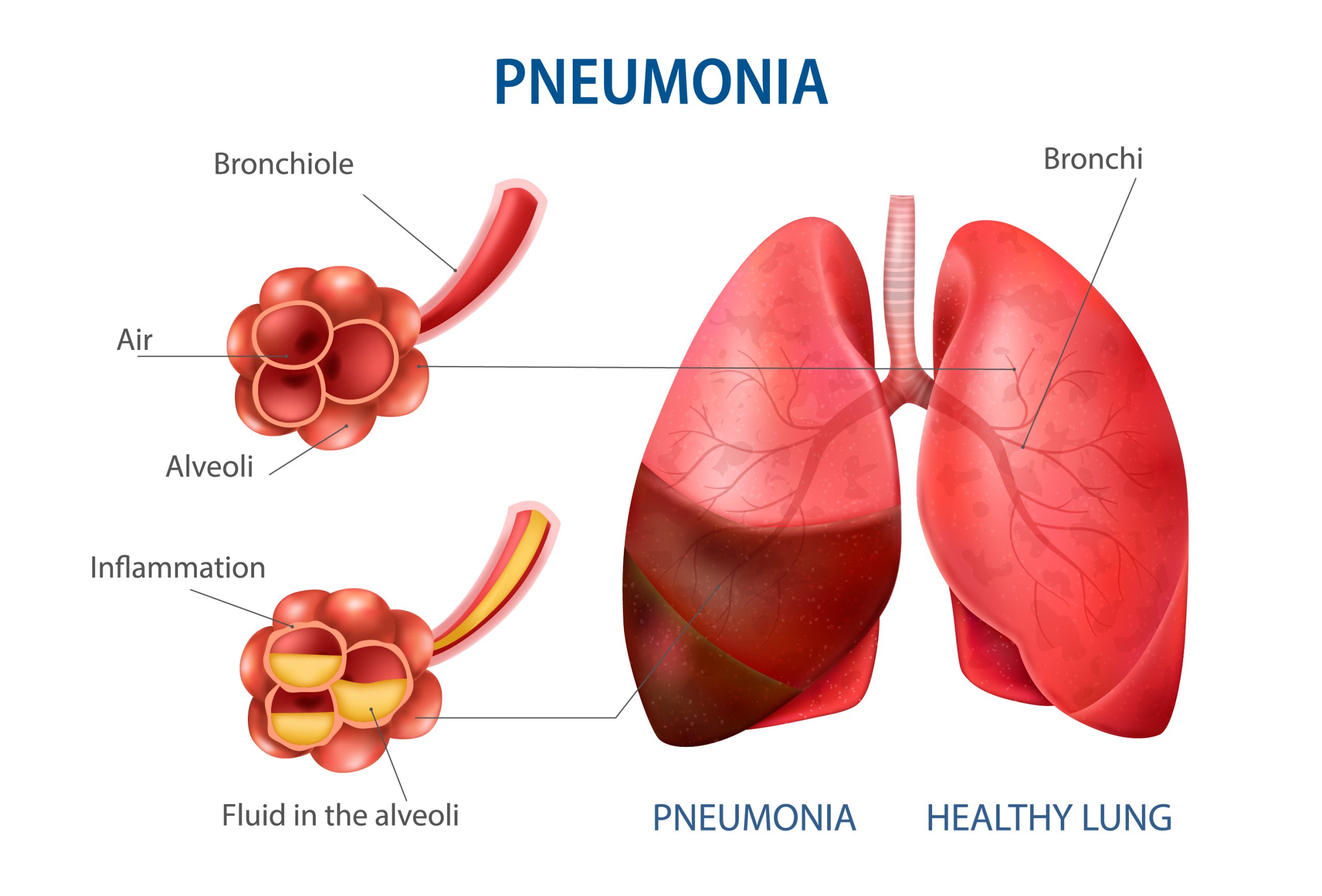 Unravelling Pneumonia: Understanding Symptoms and Causes
