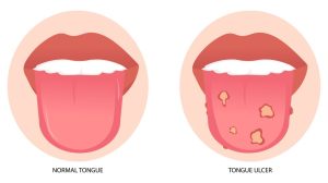 Tongue ulcer